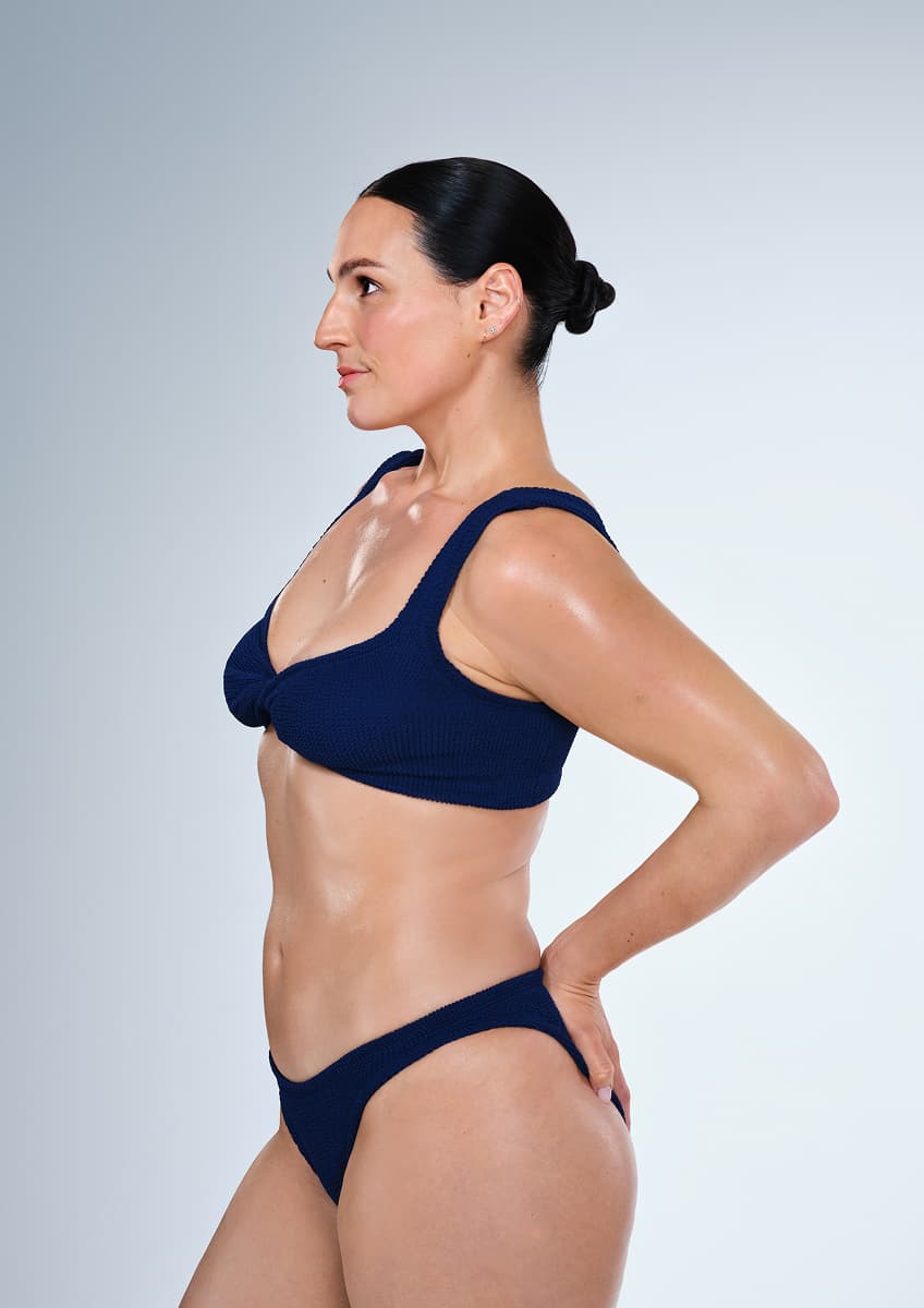 After CoolSculpting photograph of Donna, 29, actual patient