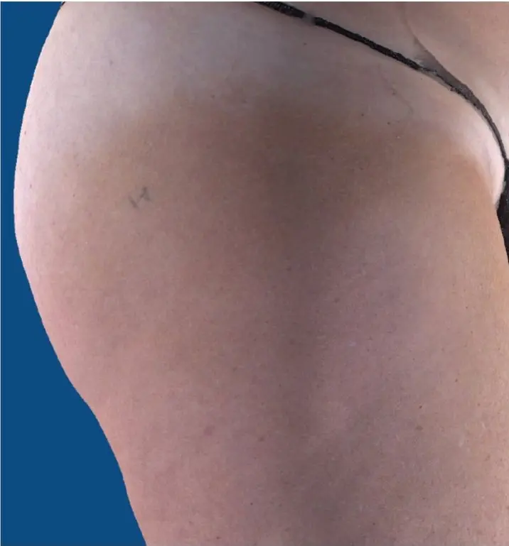 Side view of leg showing reduced cellulite after UltraSmooth treatment