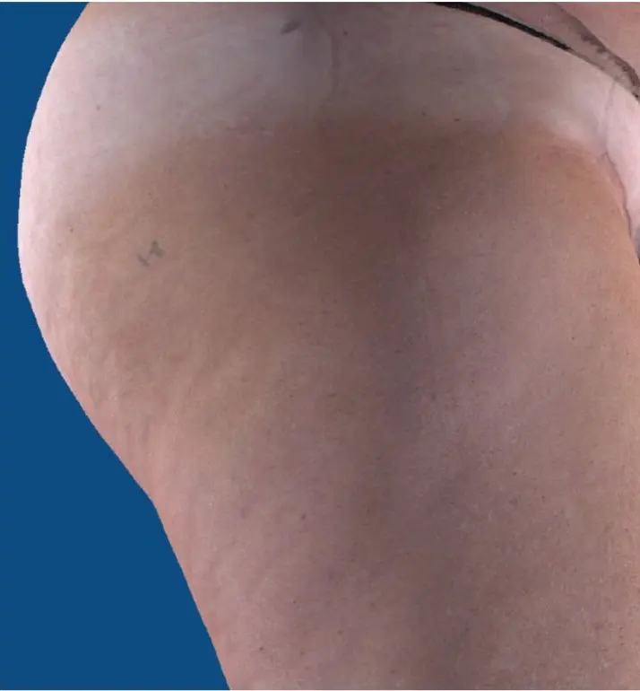 Side view of leg with cellulite before UltraSmooth treatment