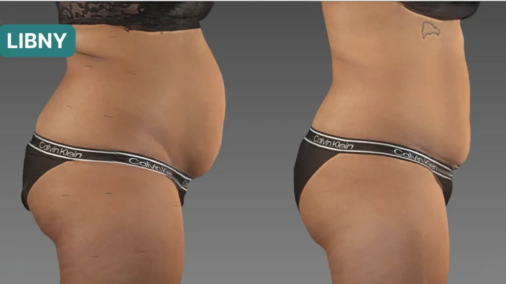 Ultraslim before and after showing red light therapy losses