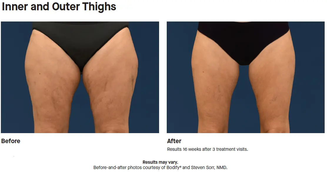 CoolSculpting-results-inner-thighs
